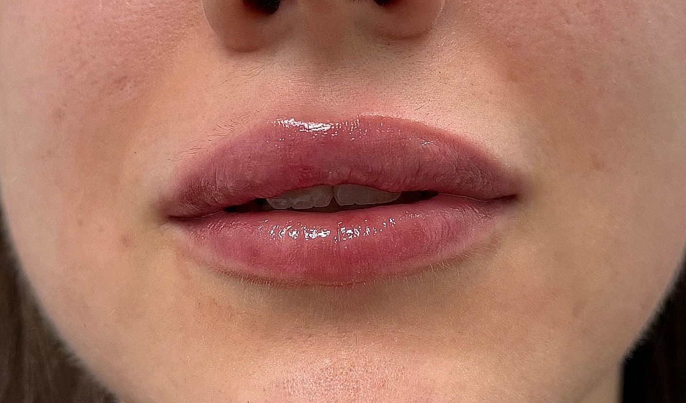 Lip Filler Before & After