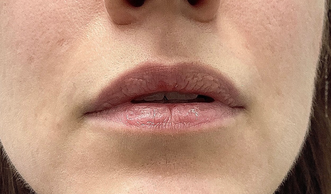 Lip Filler Before & After