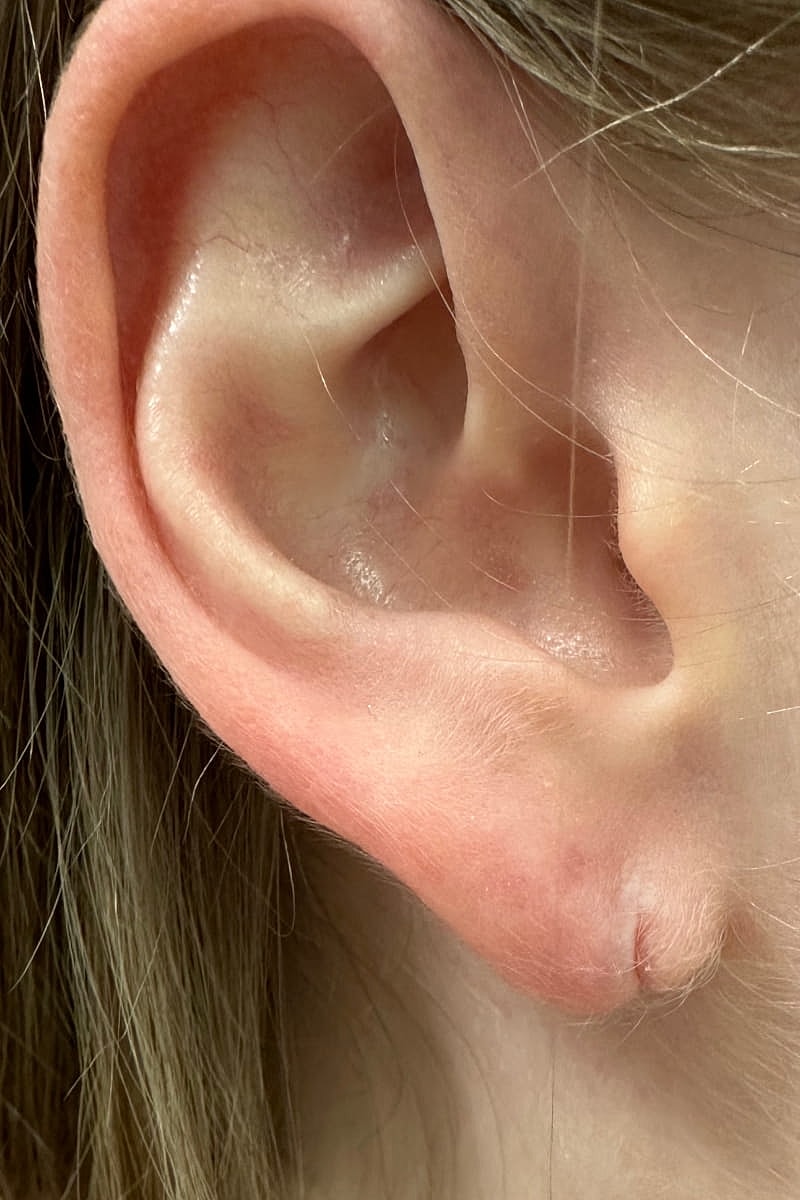 Earlobe Repair Before & After