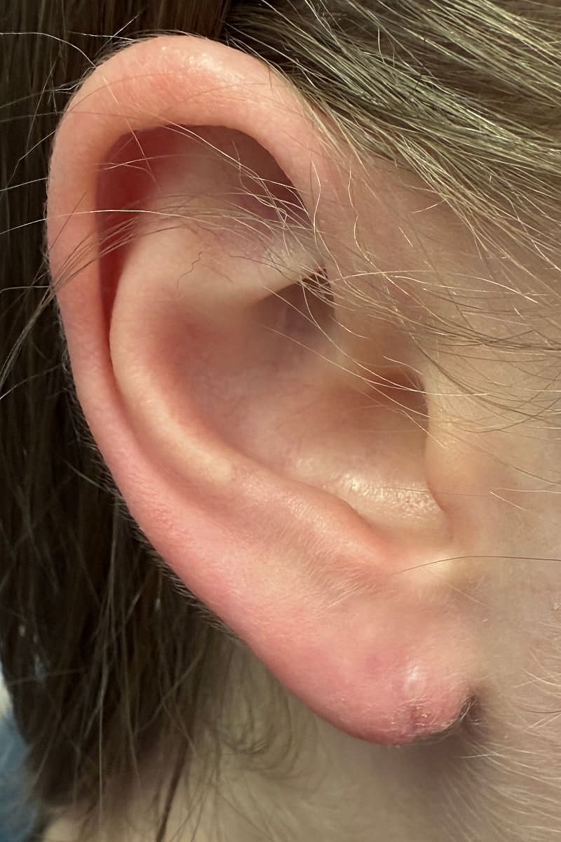Earlobe Repair Before & After