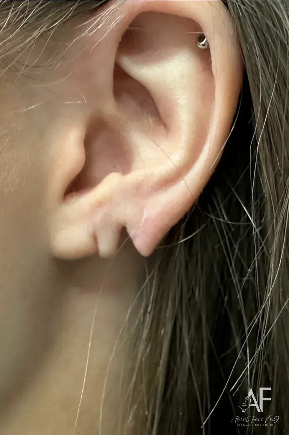 Earlobe Repair Before & After