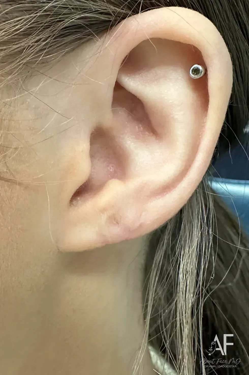 Earlobe Repair Before & After