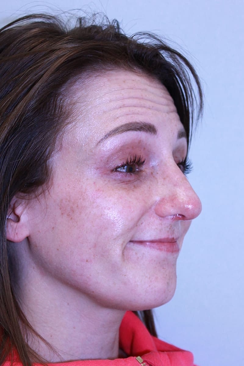 Botox/Neuromodulators Before & After