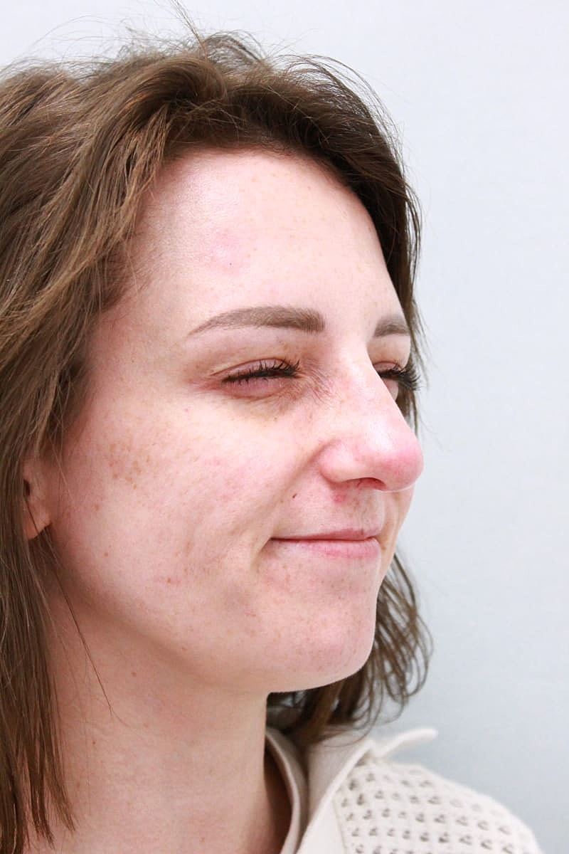 Botox/Neuromodulators Before & After