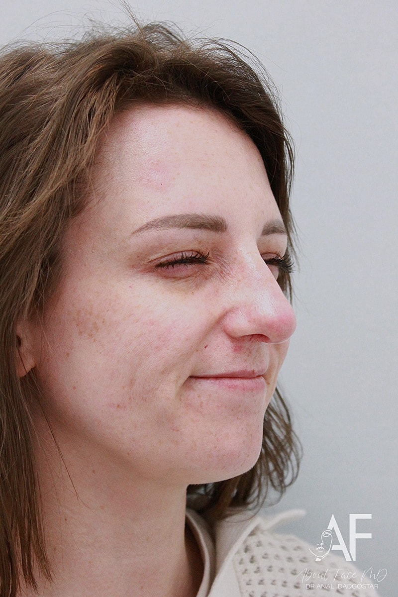 Botox/Neuromodulators Before & After