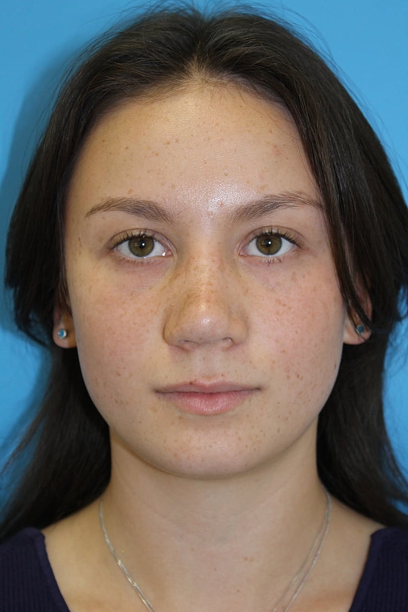 Rhinoplasty Before & After