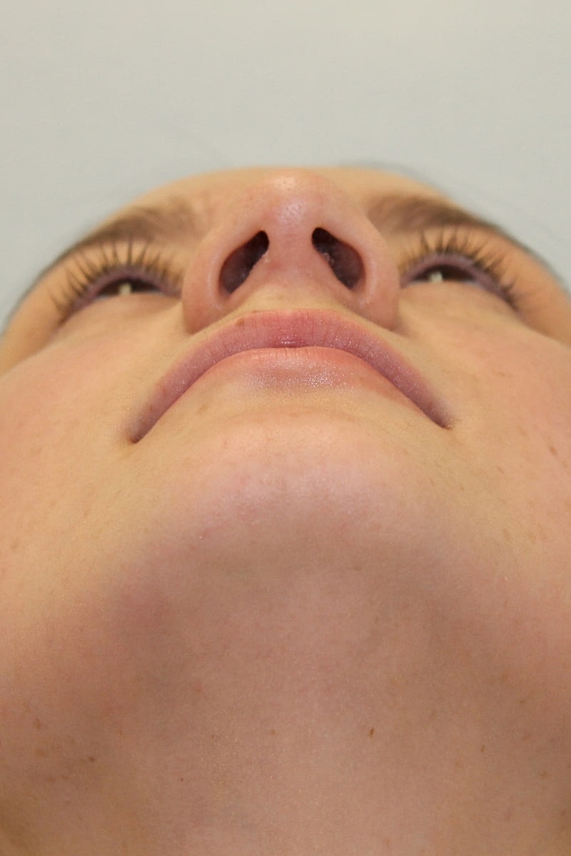 Rhinoplasty Before & After