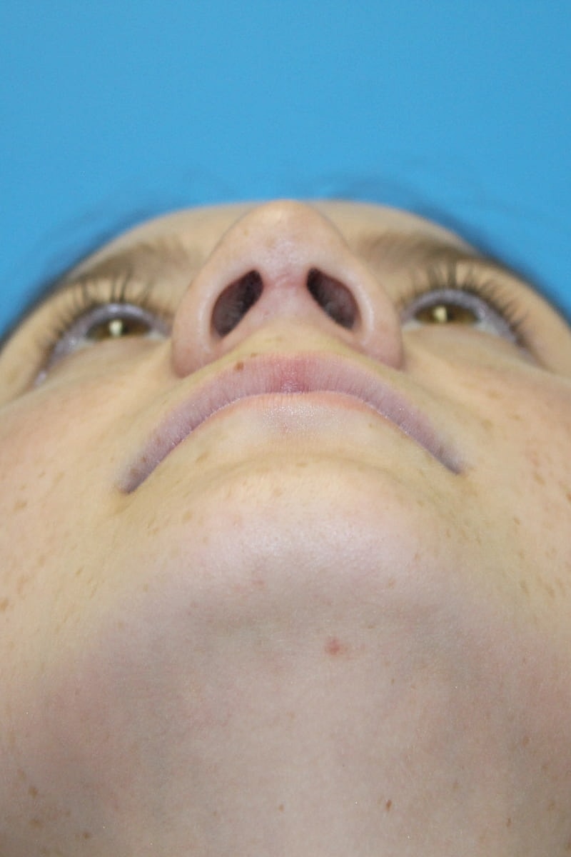 Rhinoplasty Before & After