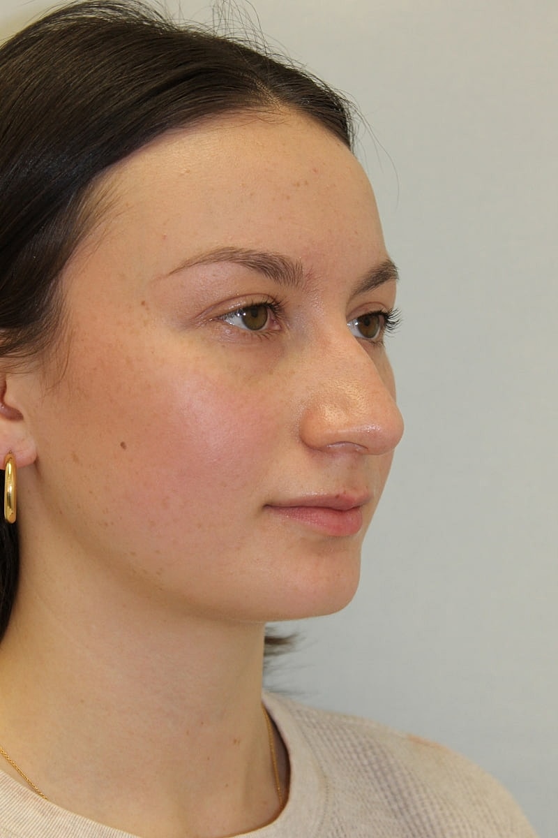 Rhinoplasty Before & After