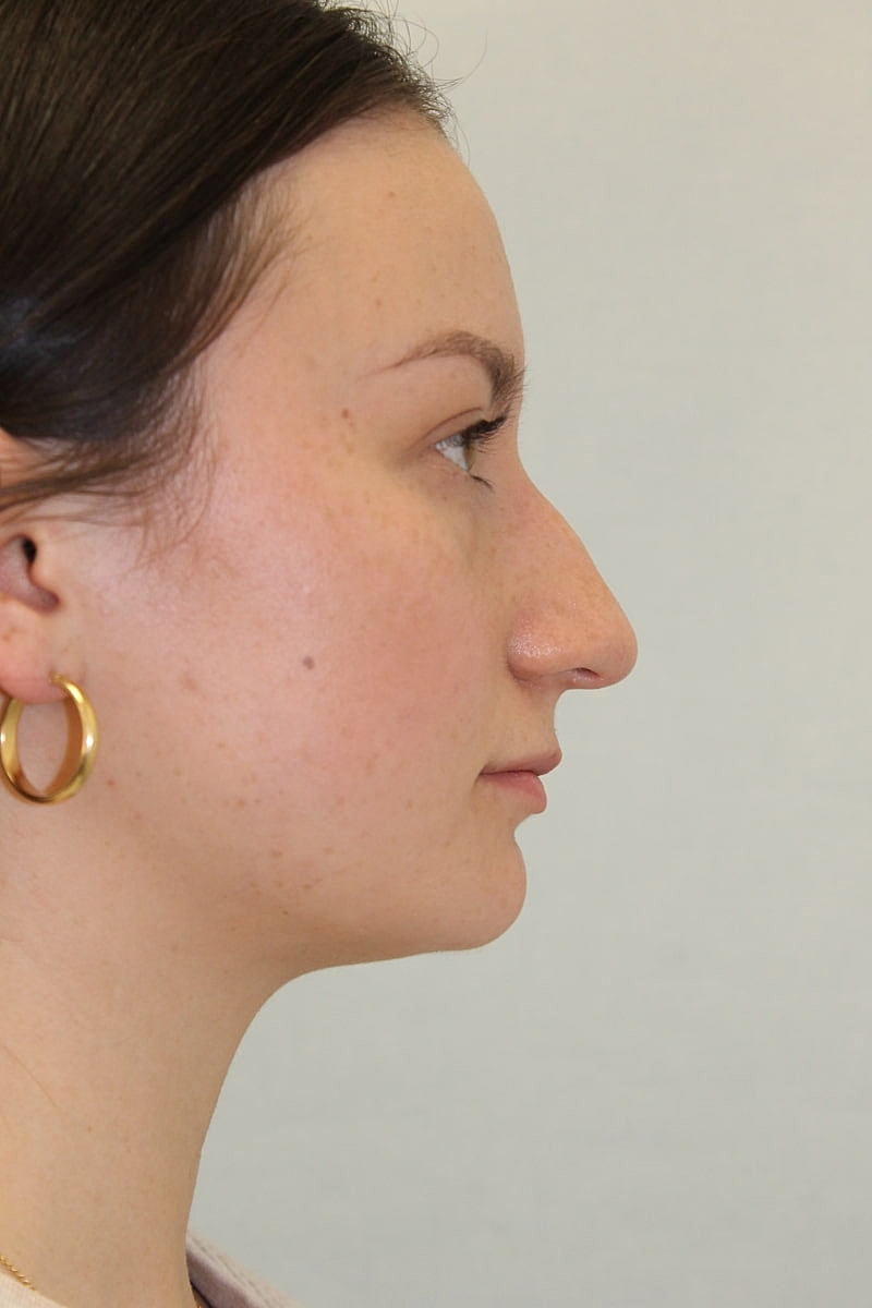 Rhinoplasty Before & After