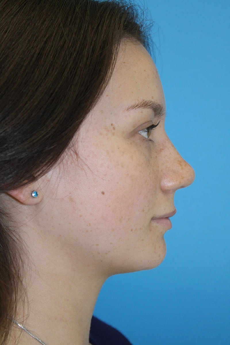 Rhinoplasty Before & After