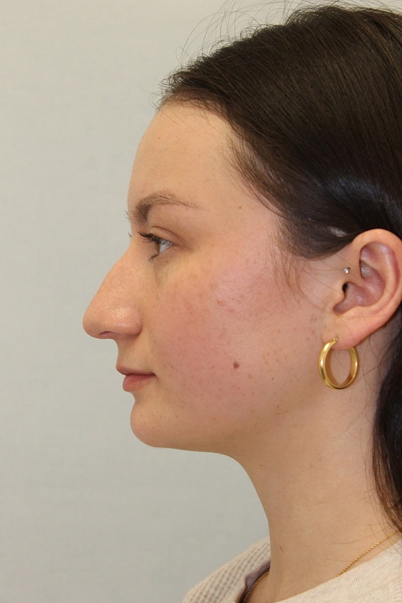 Rhinoplasty Before & After