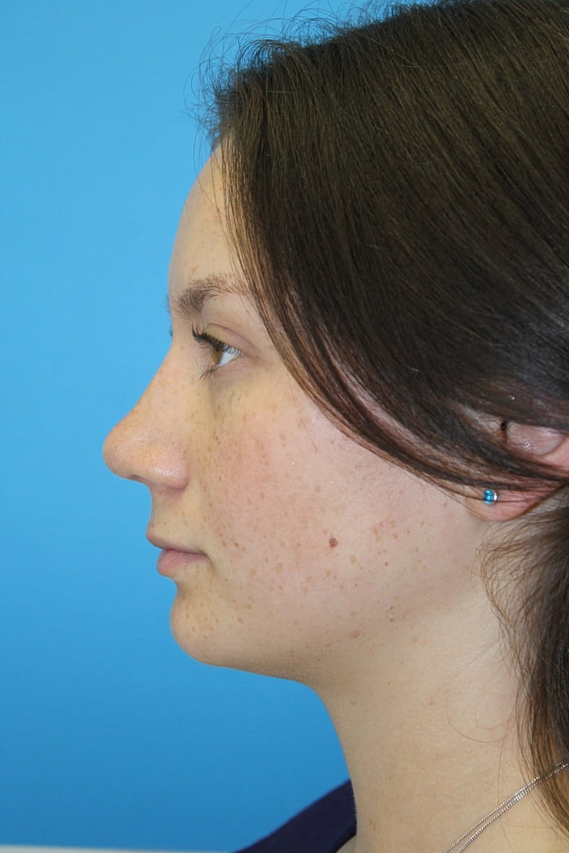 Rhinoplasty Before & After