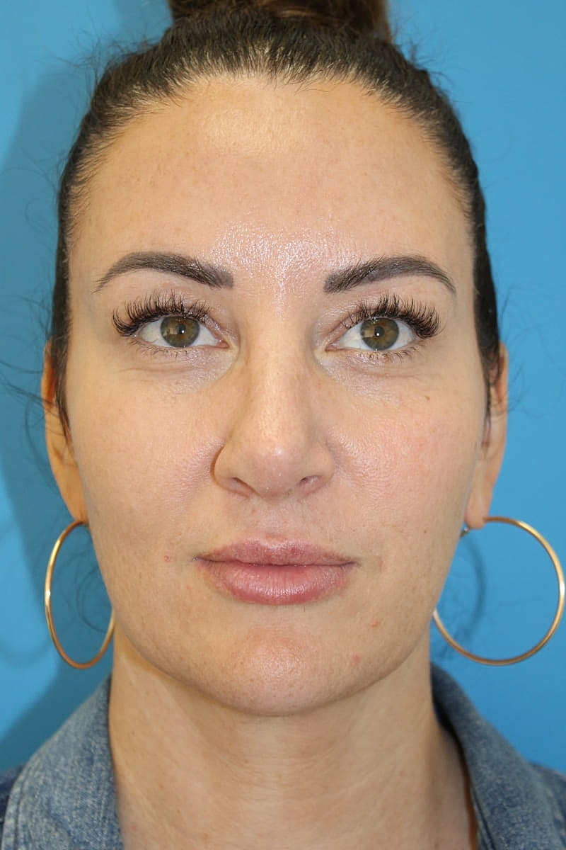 Rhinoplasty Before & After