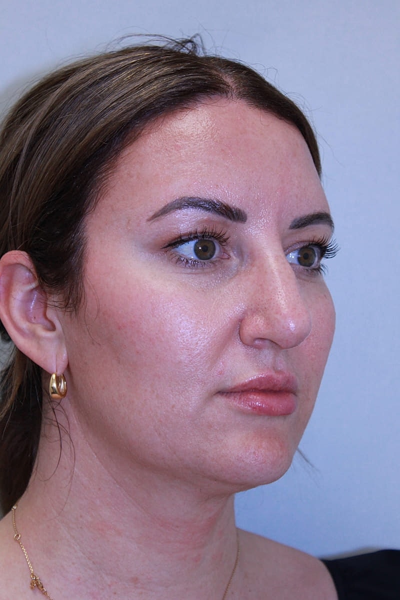 Rhinoplasty Before & After