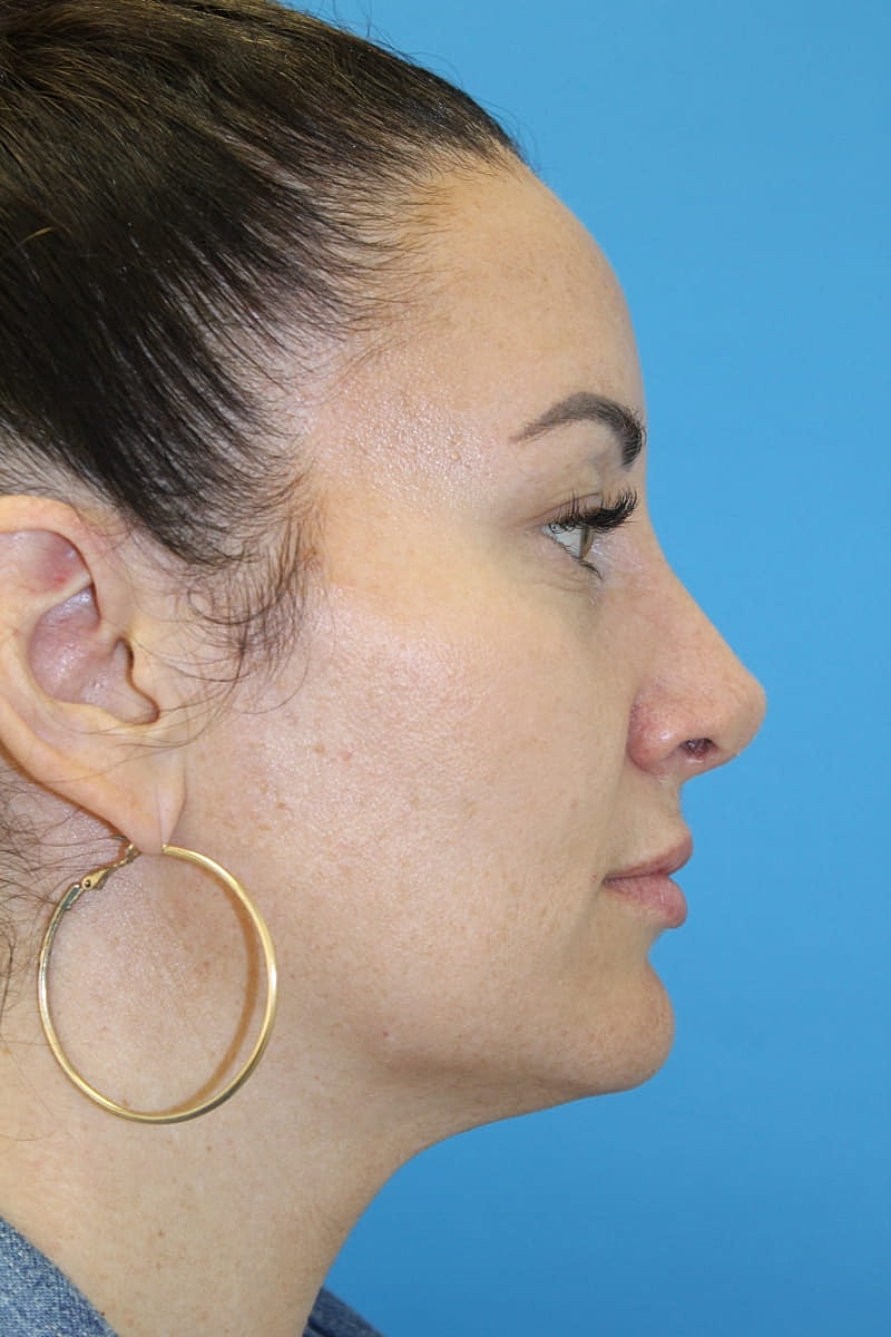 Rhinoplasty Before & After