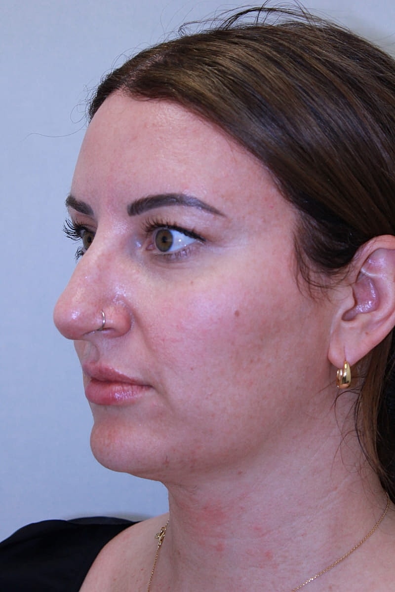 Rhinoplasty Before & After