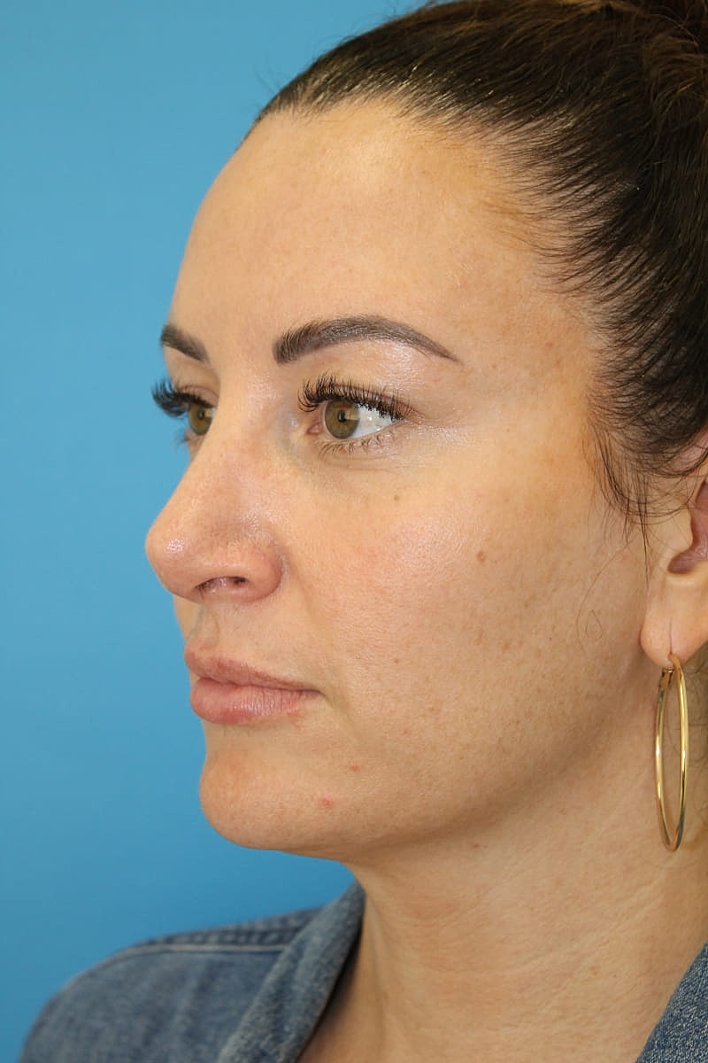 Rhinoplasty Before & After