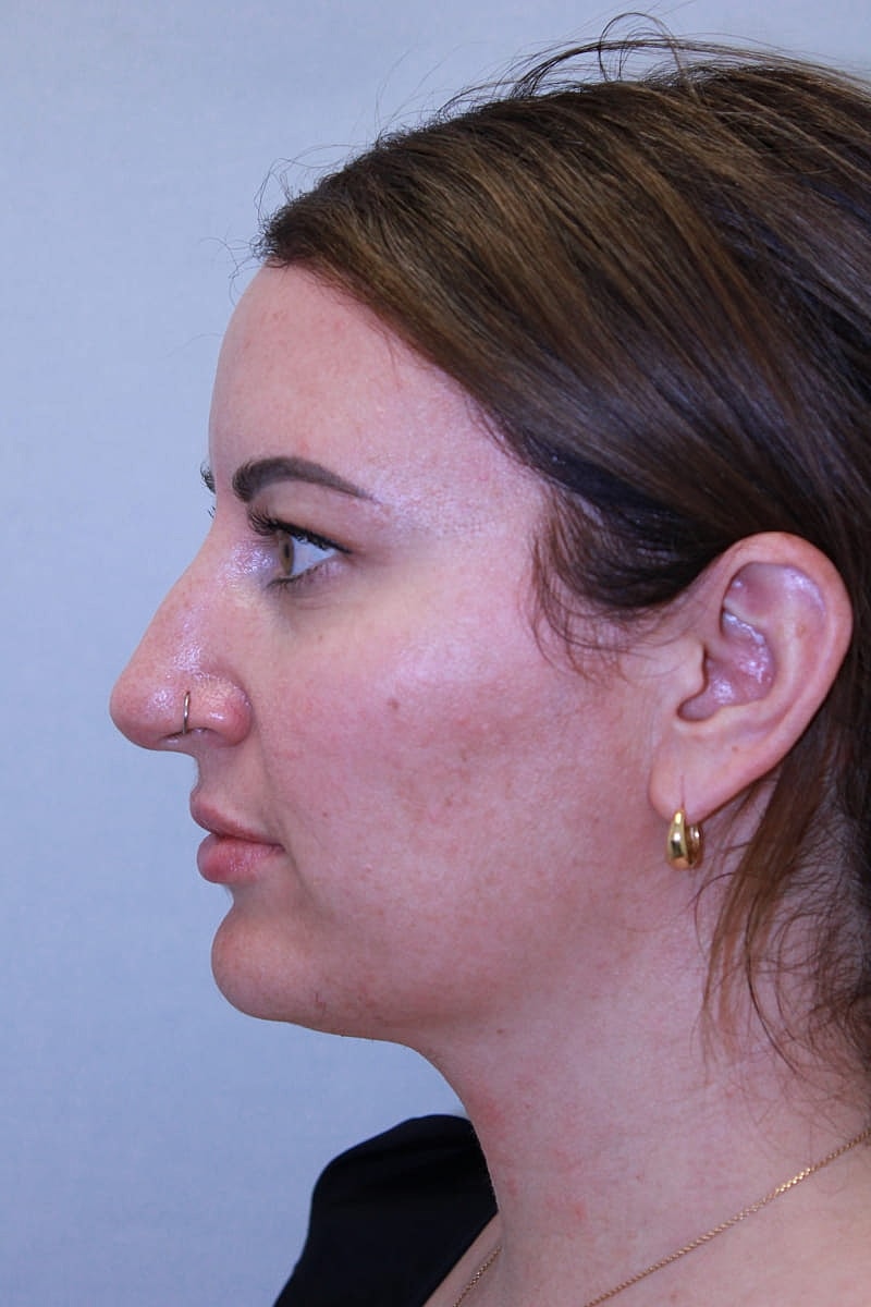 Rhinoplasty Before & After