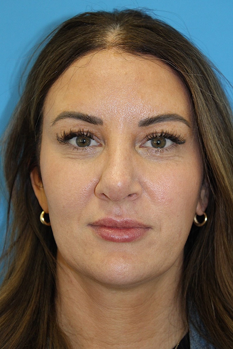 Rhinoplasty Before & After