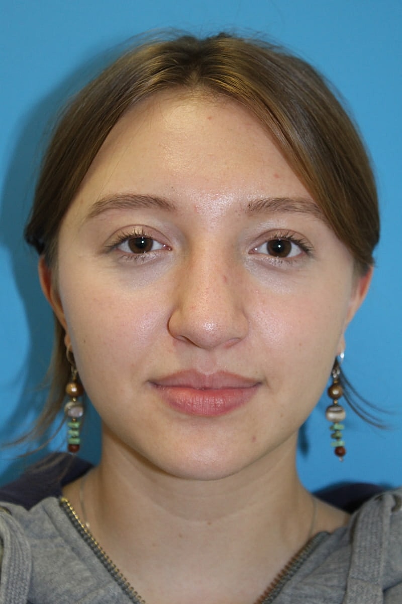 Rhinoplasty Before & After