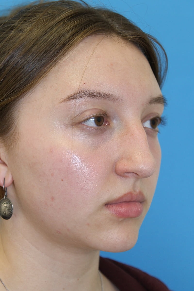 Rhinoplasty Before & After