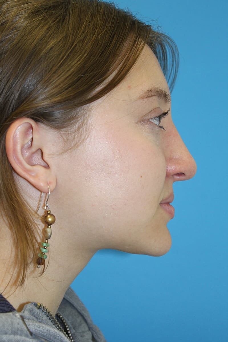 Rhinoplasty Before & After