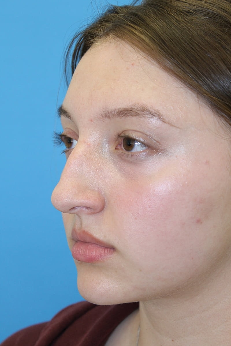 Rhinoplasty Before & After