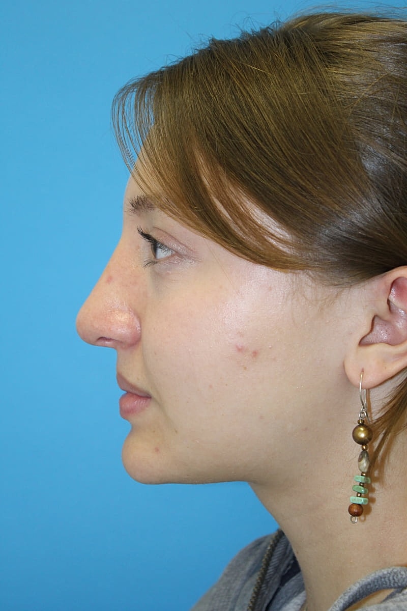 Rhinoplasty Before & After