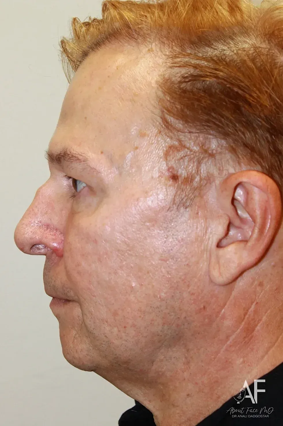 Rhinoplasty Before & After