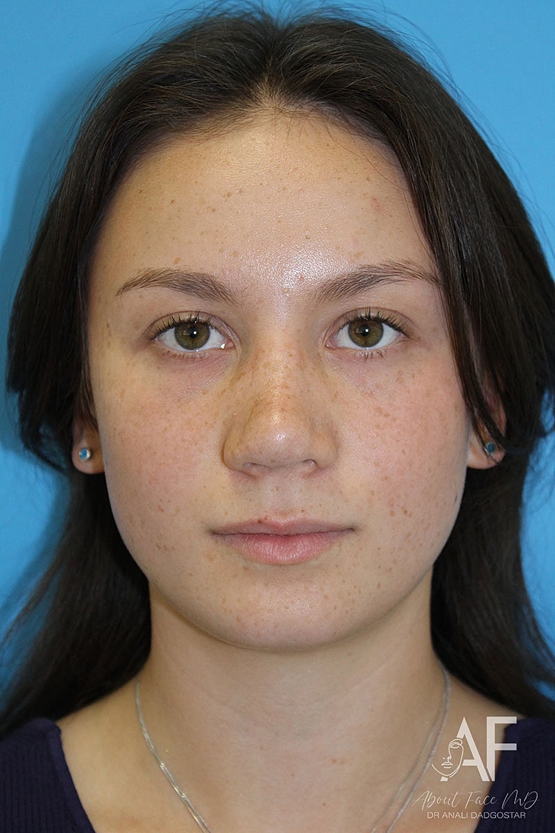 Rhinoplasty Before & After