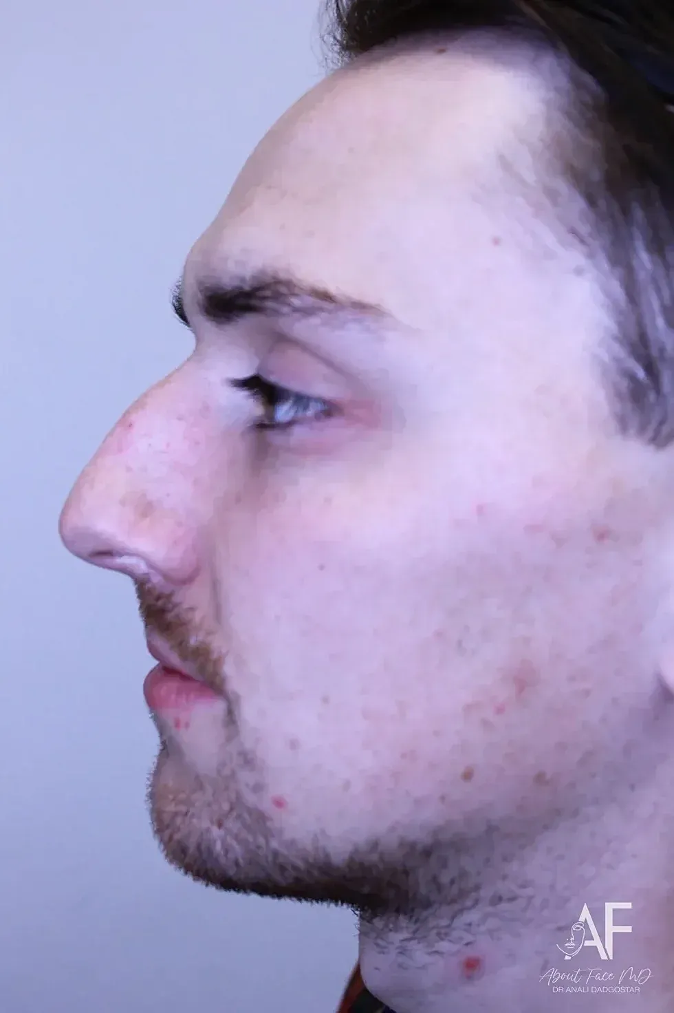 Rhinoplasty Before & After