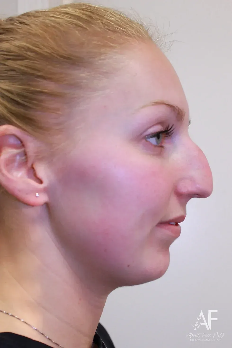 Rhinoplasty Before & After