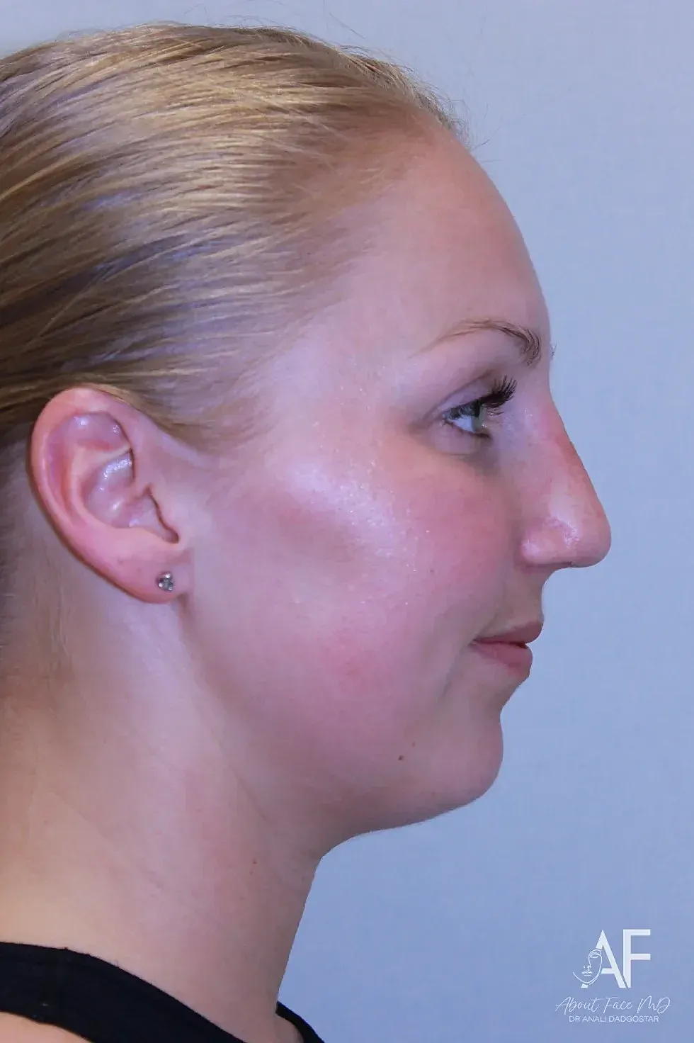 Rhinoplasty Before & After
