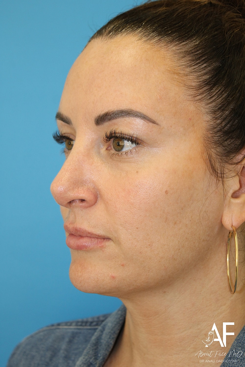 Rhinoplasty Before & After