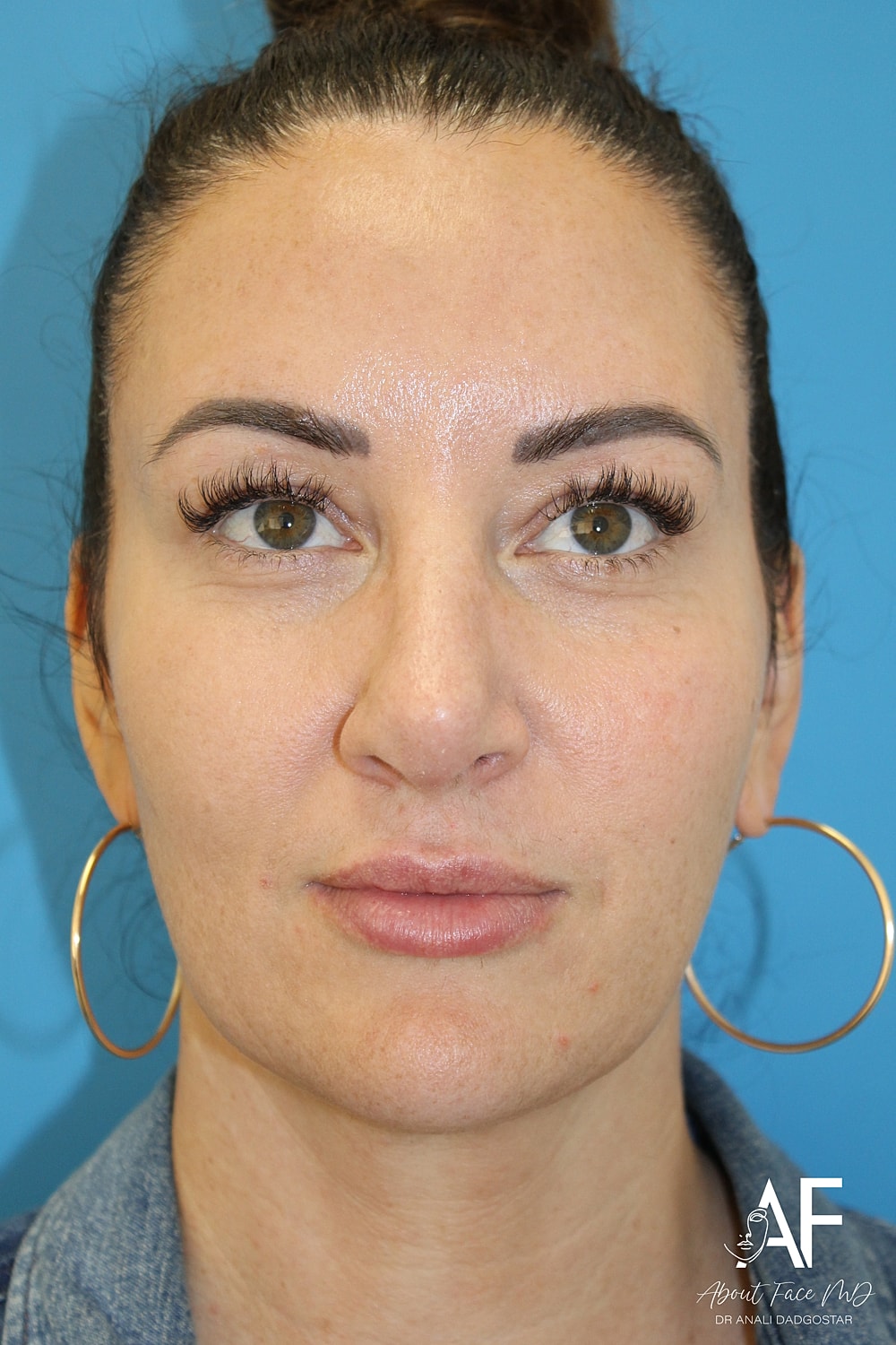 Rhinoplasty Before & After