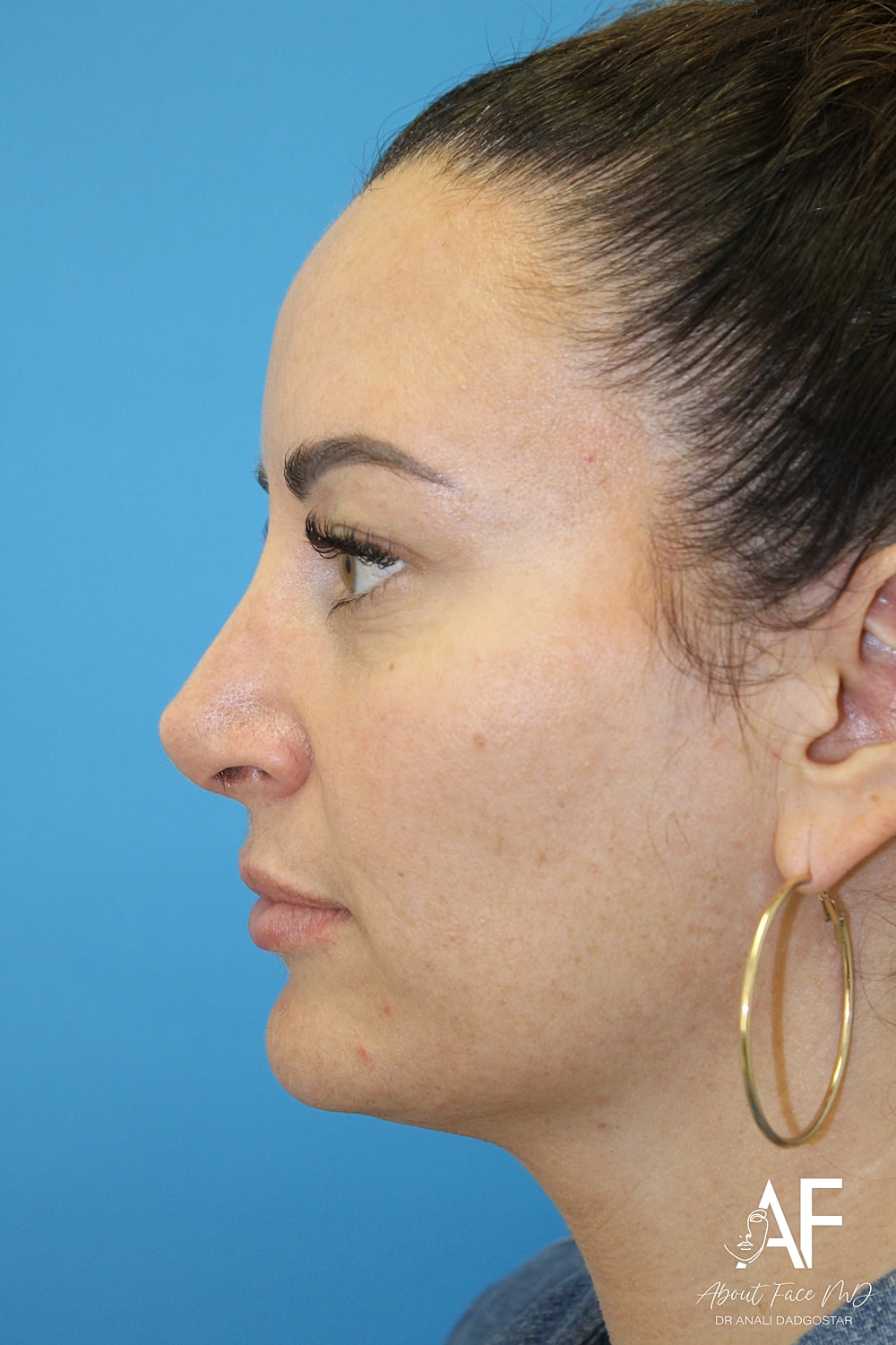 Rhinoplasty Before & After