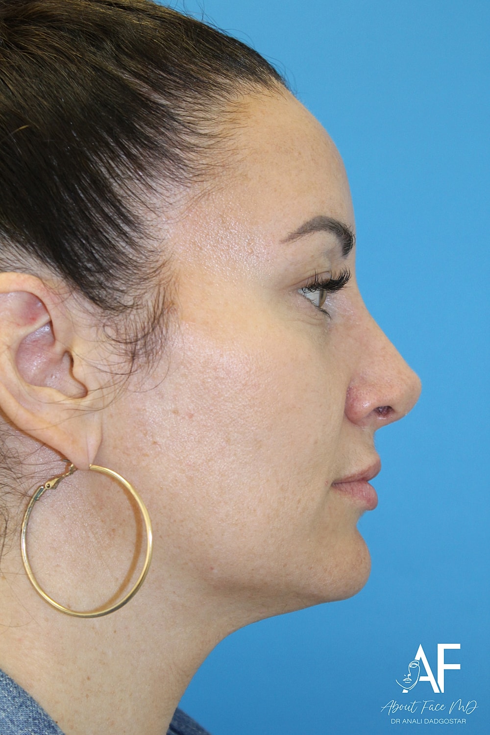 Rhinoplasty Before & After