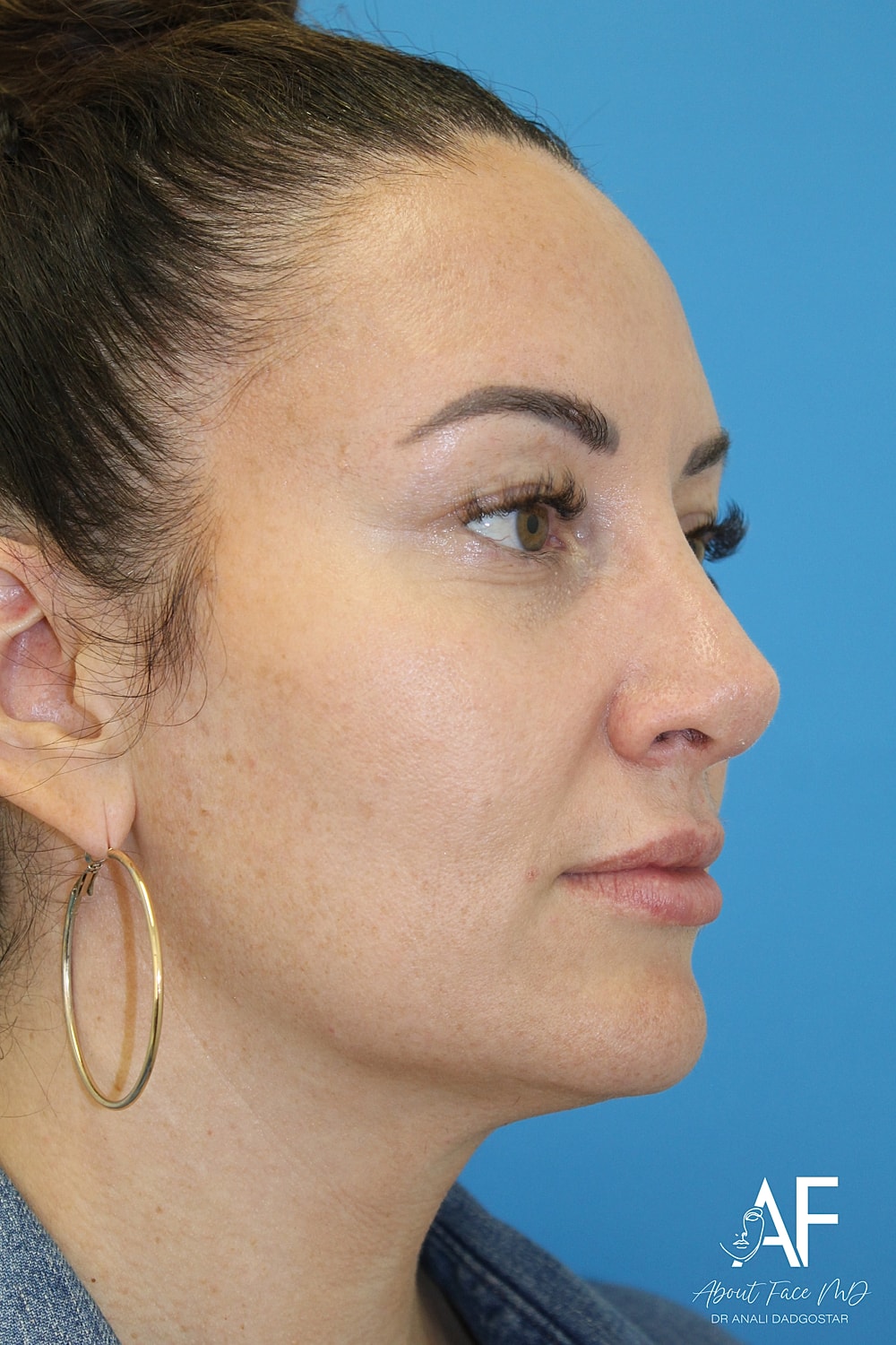 Rhinoplasty Before & After