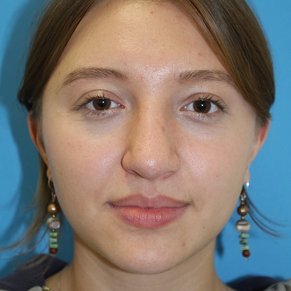 Rhinoplasty Before & After