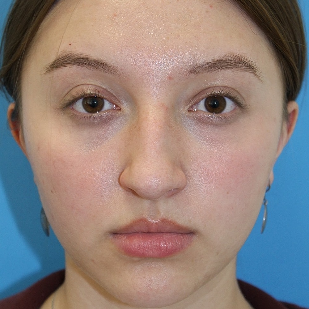Rhinoplasty Before & After
