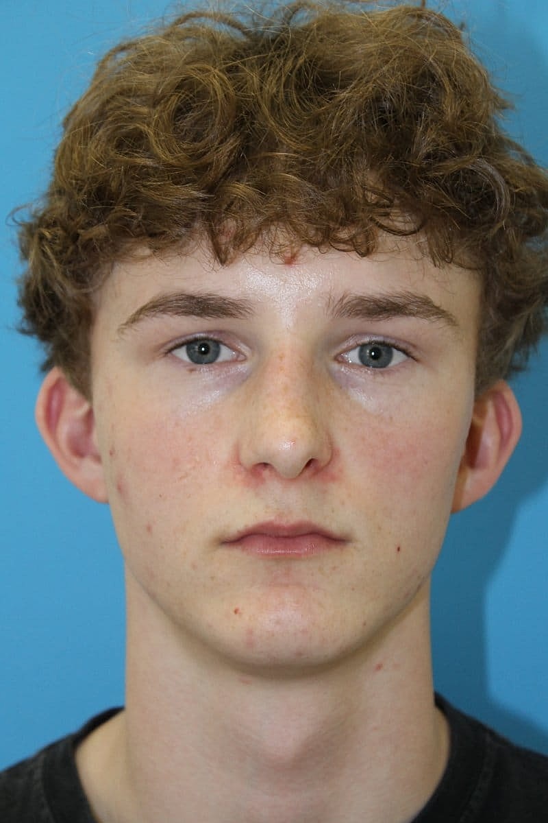 Otoplasty Before & After