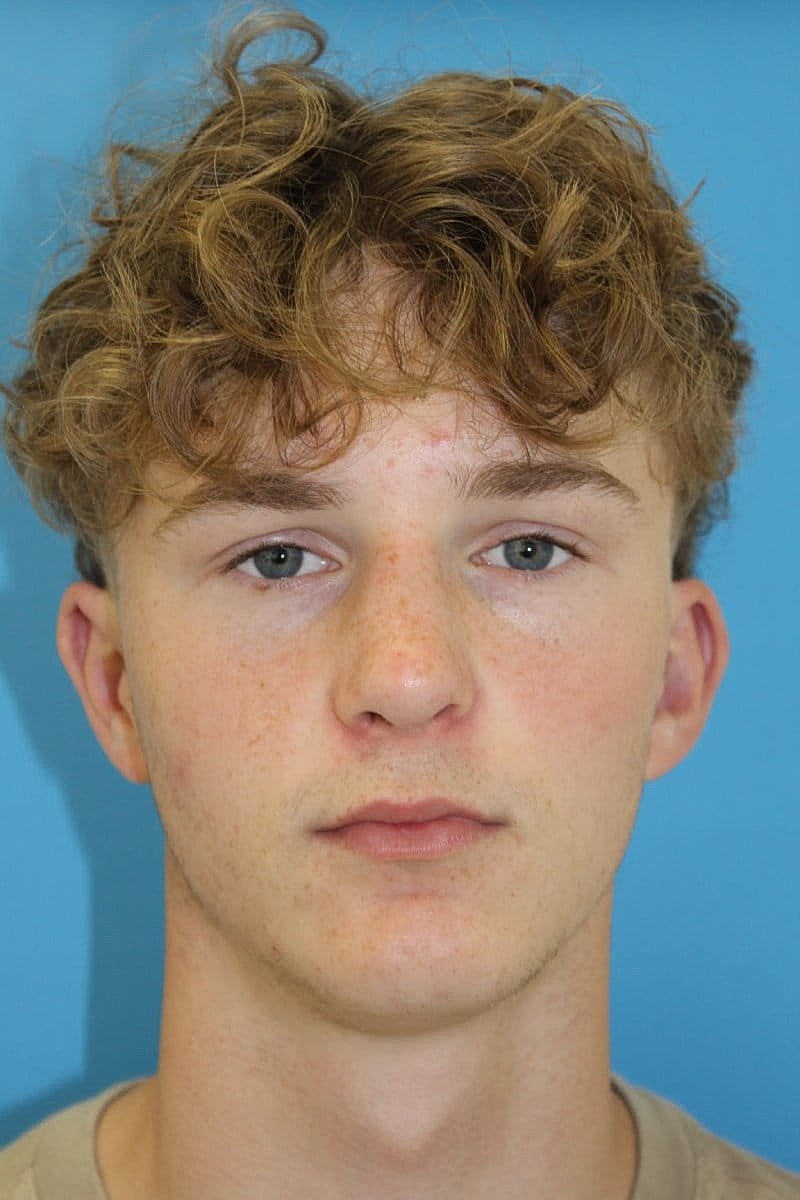 Otoplasty Before & After