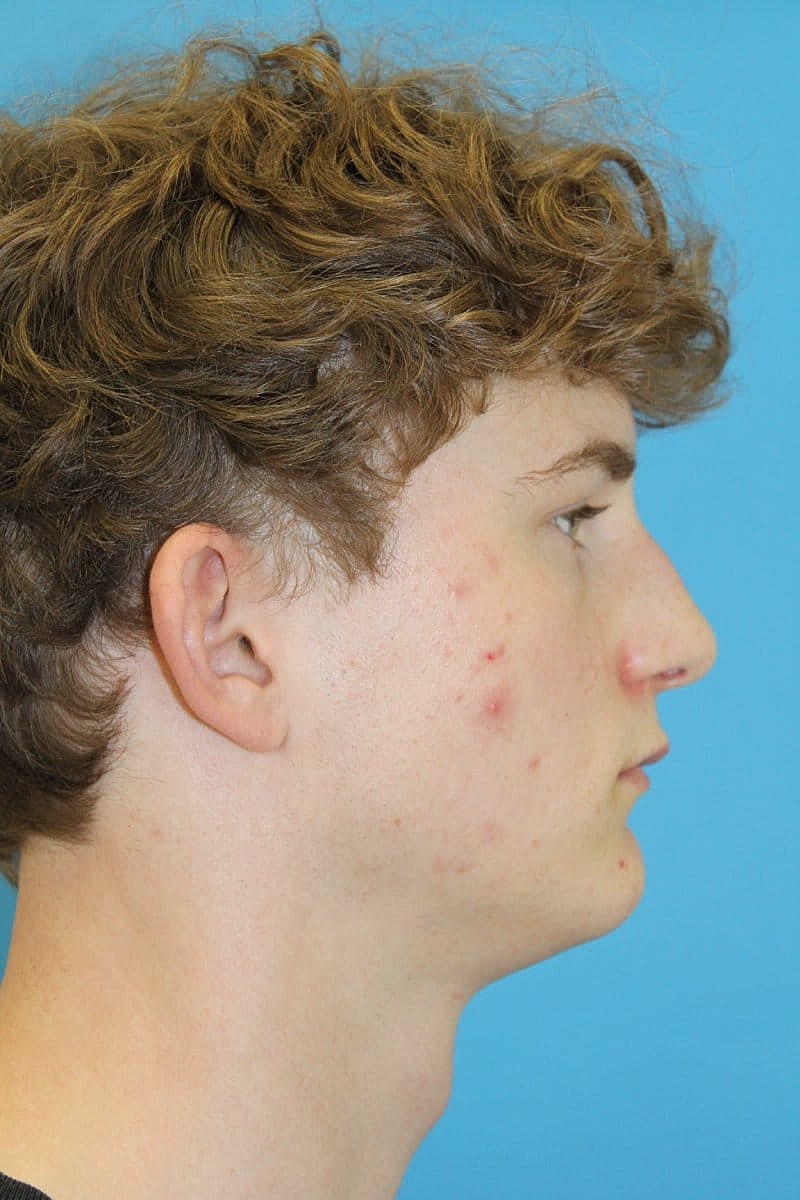 Otoplasty Before & After