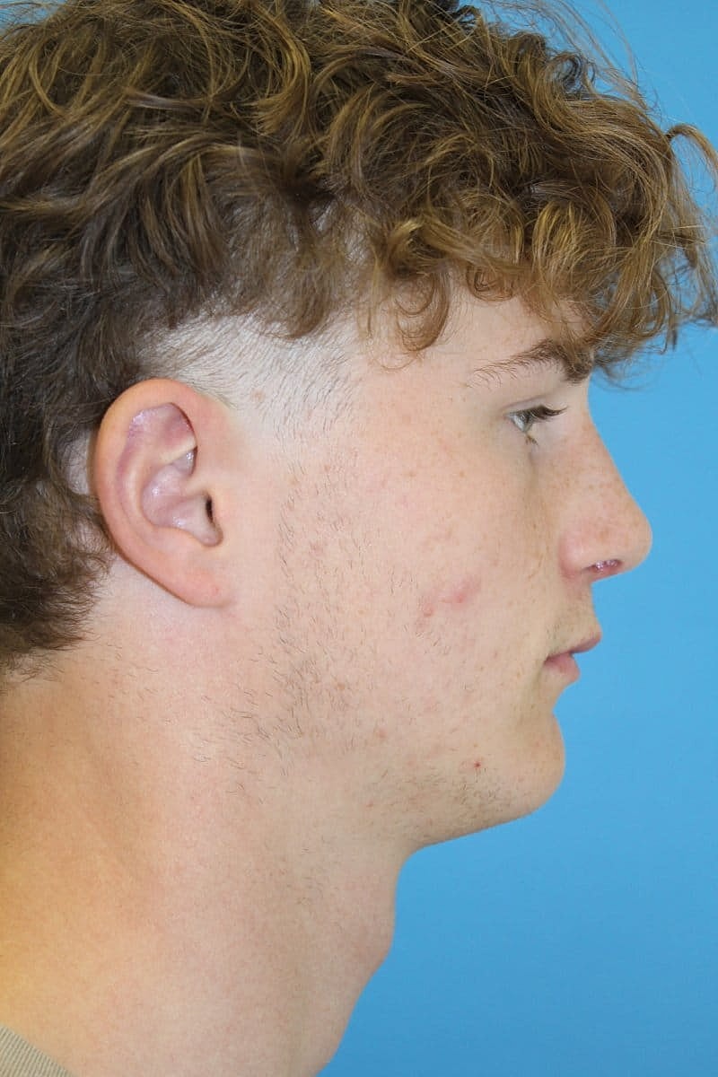 Otoplasty Before & After