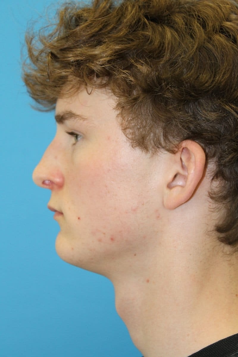 Otoplasty Before & After