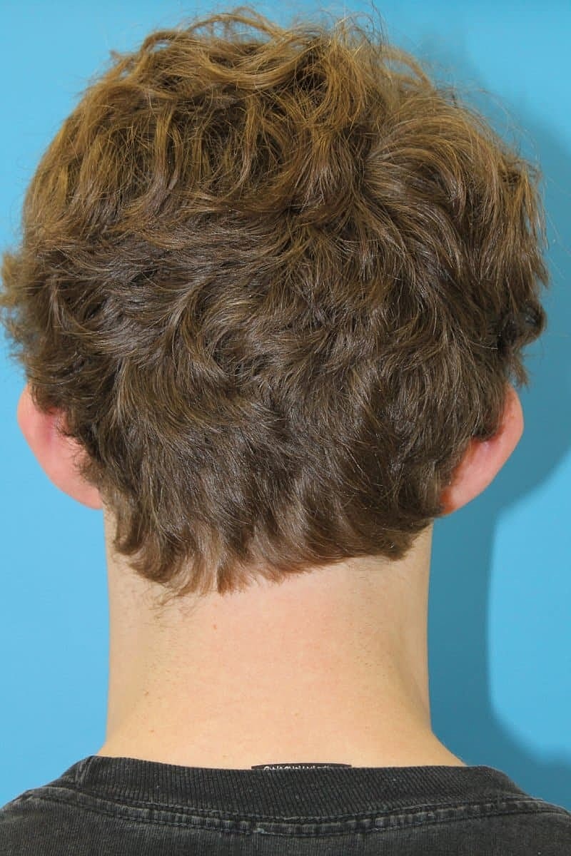 Otoplasty Before & After