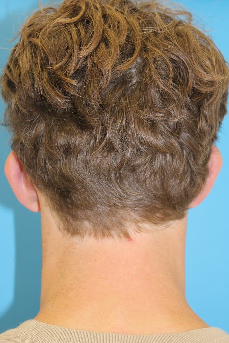 Otoplasty Before & After