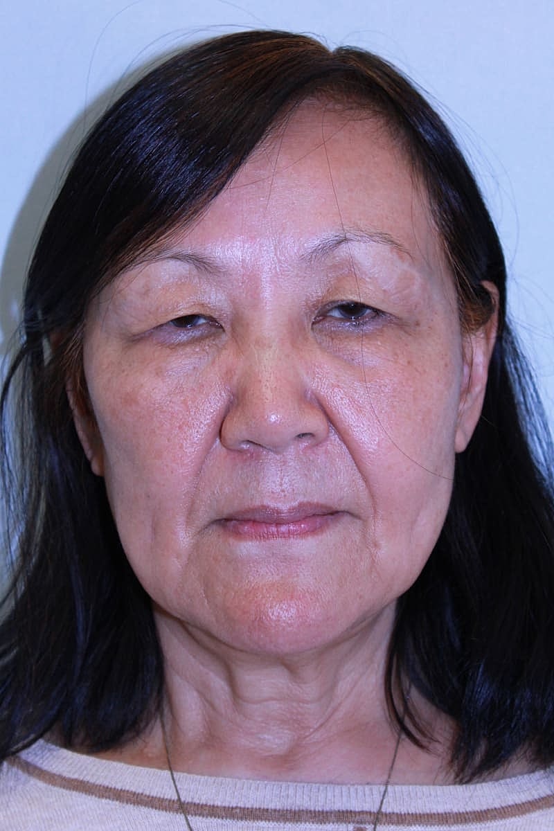 Upper Blepharoplasty Before & After
