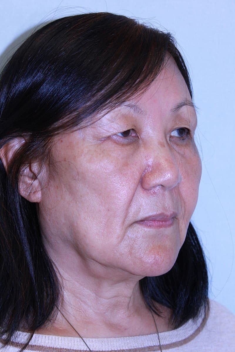 Upper Blepharoplasty Before & After